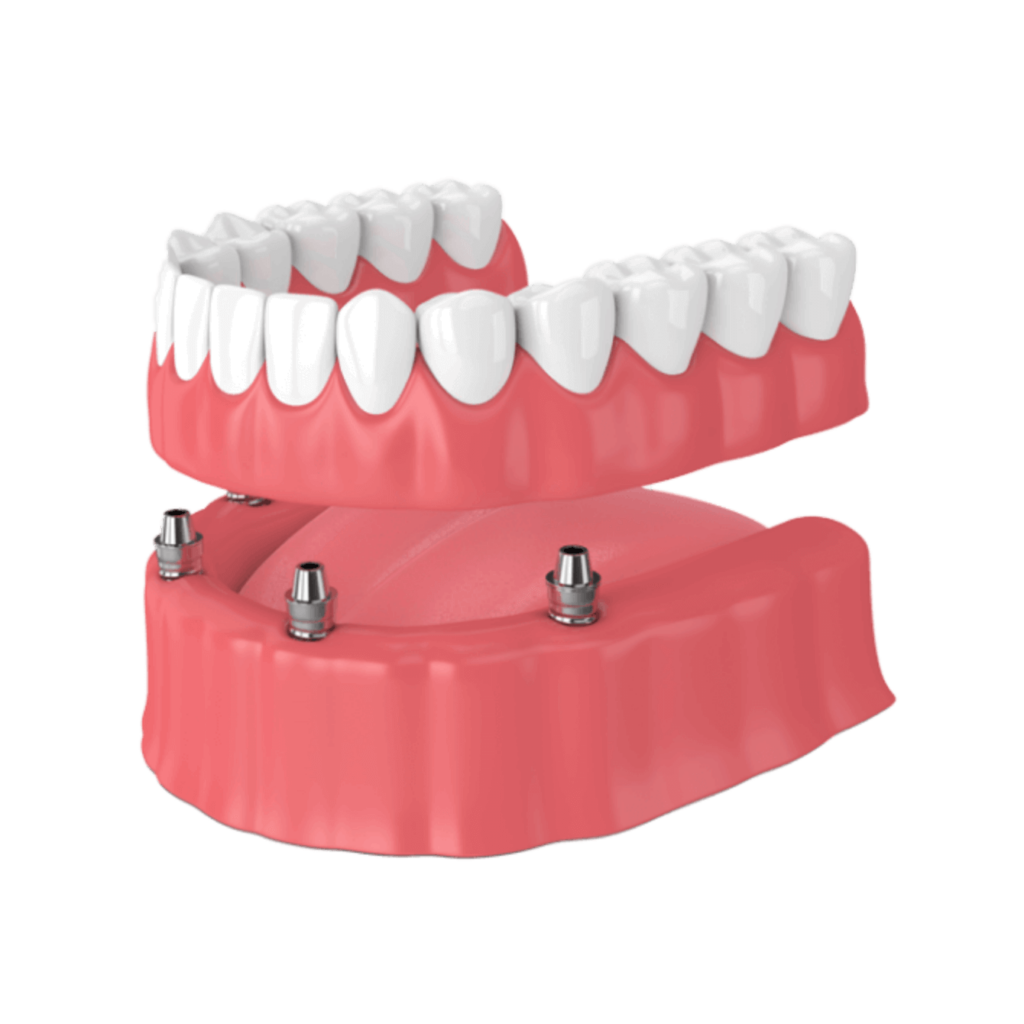 Implant supported denture